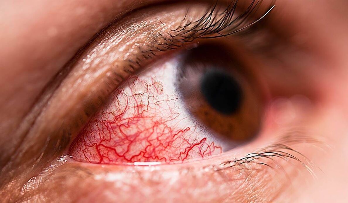 Diabetische Retinopathie ist eine der späten Diabetes -Komplikationen